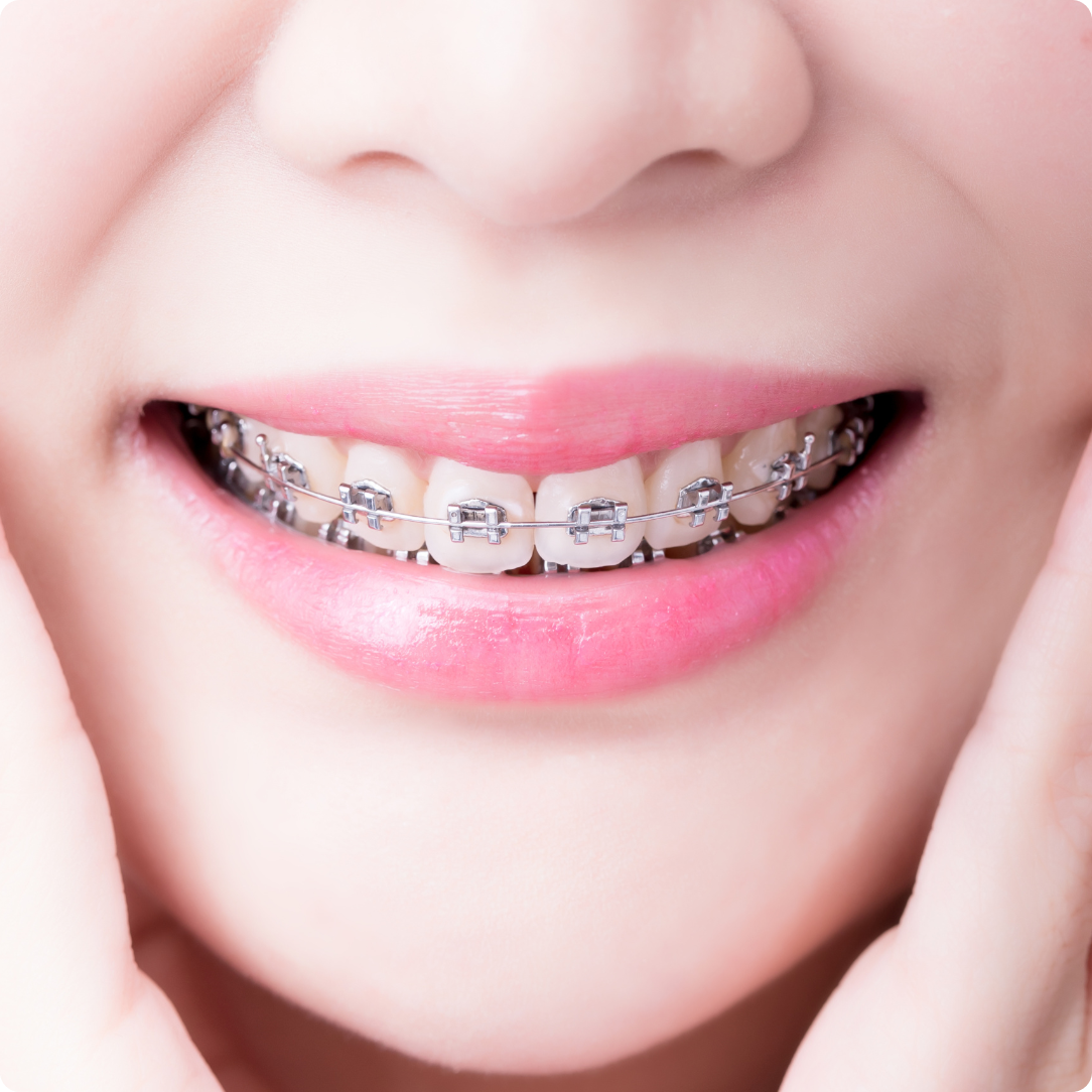 como_clarear_os_dentes_depois_do_aparelho_dental