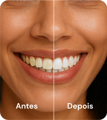 Combo Sorriso Perfeito - Fitas Clareadoras + Caneta Clareadora